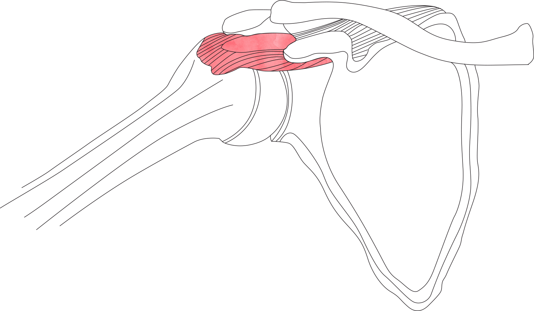 0017_Shoulder-Impingement-